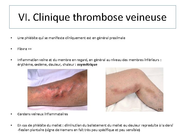 VI. Clinique thrombose veineuse • Une phlébite qui se manifeste cliniquement est en général