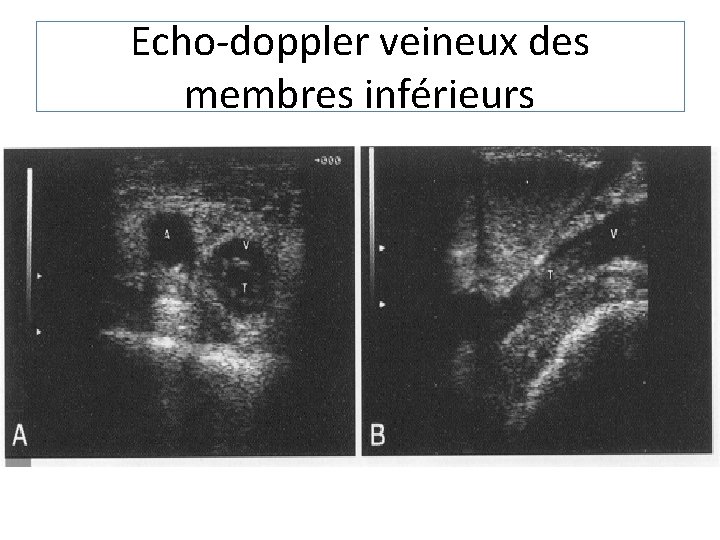 Echo-doppler veineux des membres inférieurs 