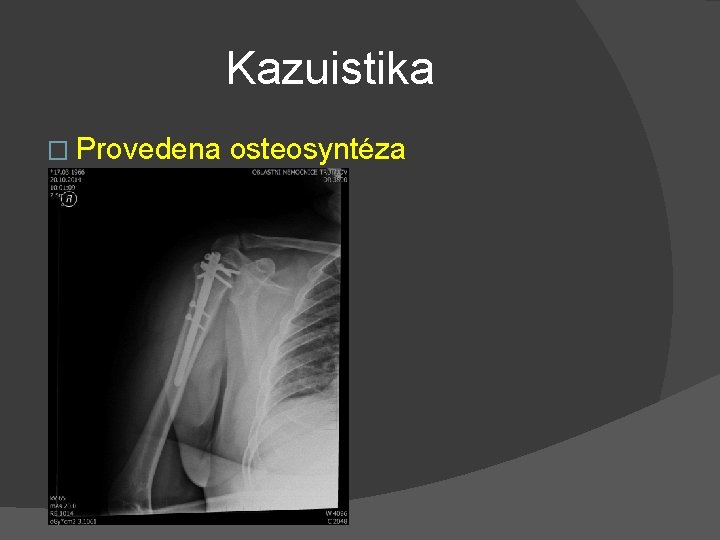 Kazuistika � Provedena osteosyntéza 