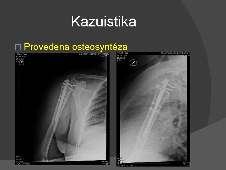 Kazuistika � Provedena osteosyntéza 