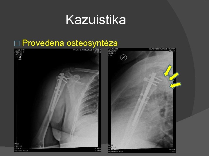 Kazuistika � Provedena osteosyntéza 