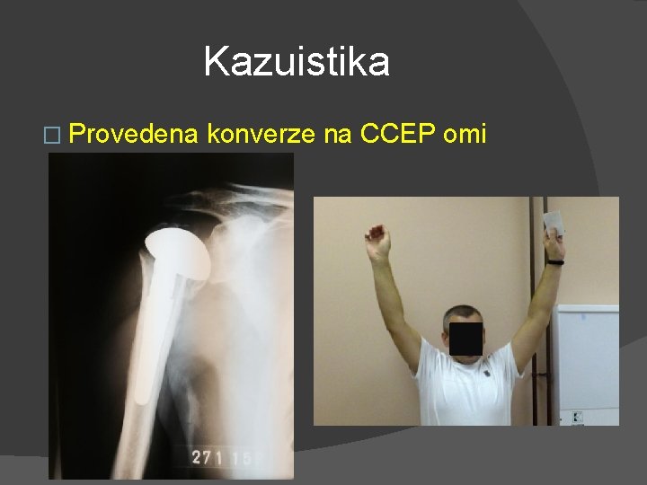 Kazuistika � Provedena konverze na CCEP omi 