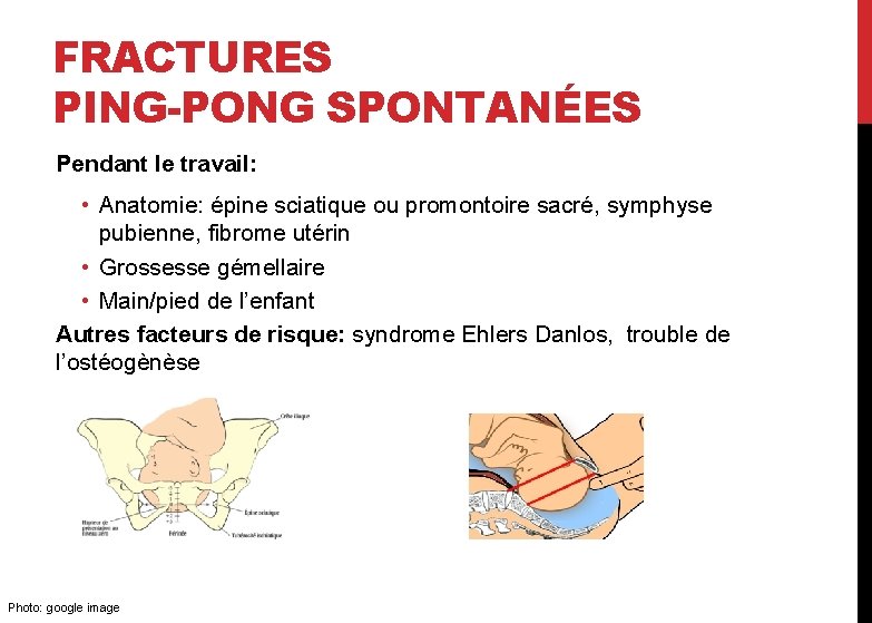 FRACTURES PING-PONG SPONTANÉES Pendant le travail: • Anatomie: épine sciatique ou promontoire sacré, symphyse