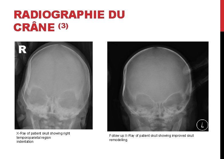 RADIOGRAPHIE DU CR NE (3) X-Ray of patient skull showing right temporoparietal region indentation