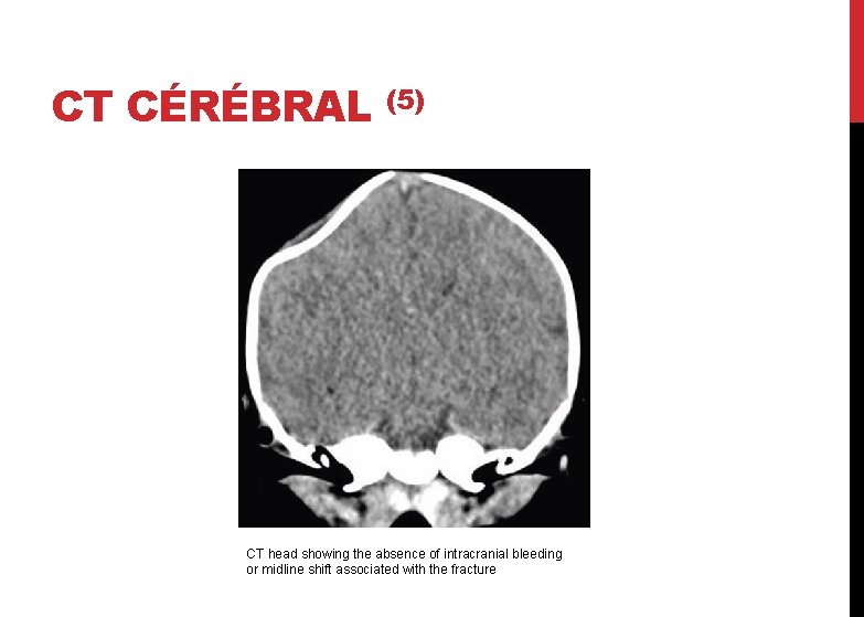 CT CÉRÉBRAL (5) CT head showing the absence of intracranial bleeding or midline shift