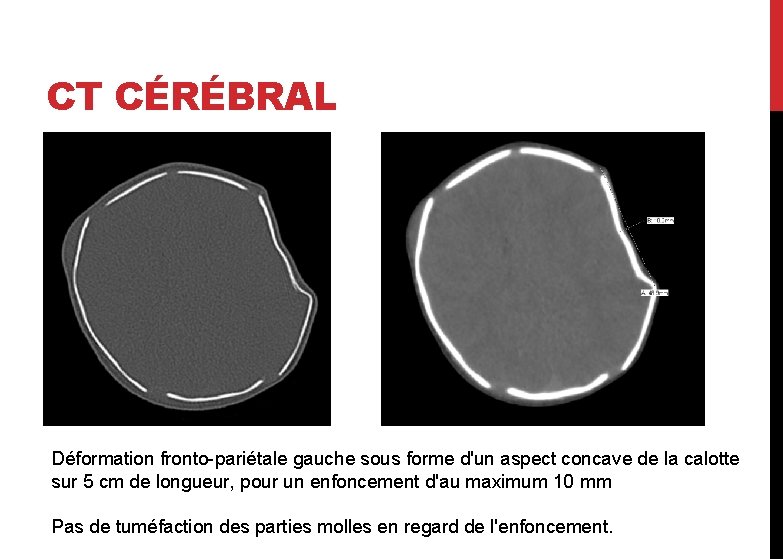 CT CÉRÉBRAL Déformation fronto-pariétale gauche sous forme d'un aspect concave de la calotte sur