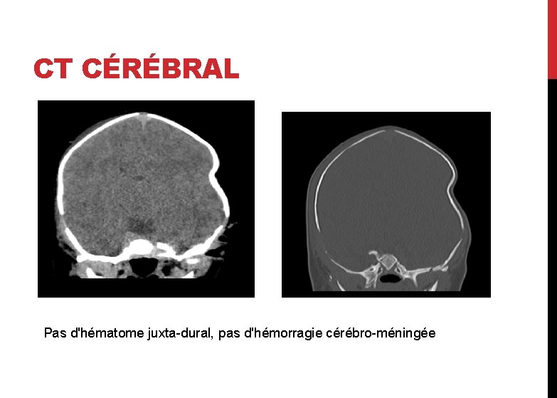 CT CÉRÉBRAL Pas d'hématome juxta-dural, pas d'hémorragie cérébro-méningée 