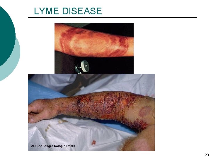 LYME DISEASE 23 