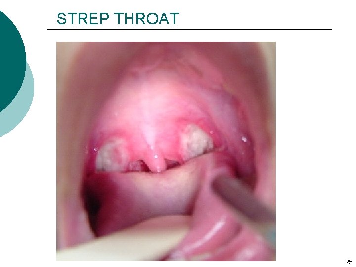 STREP THROAT 25 