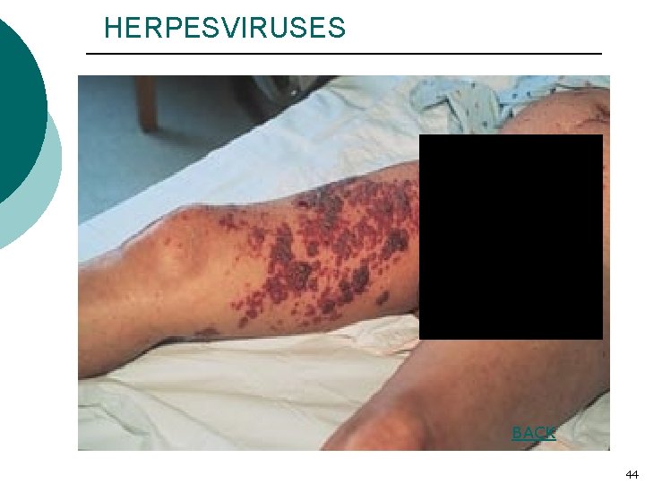 HERPESVIRUSES BACK 44 