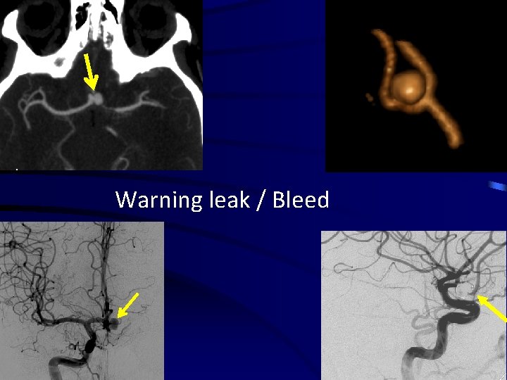 Warning leak / Bleed 