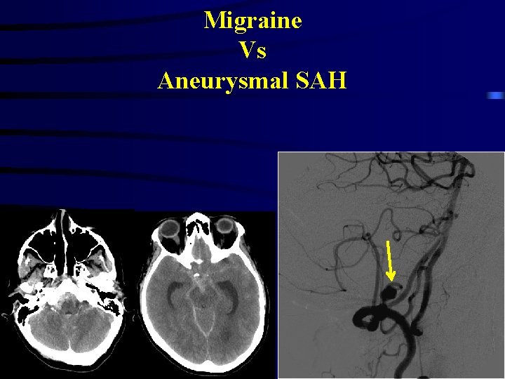 Migraine Vs Aneurysmal SAH 