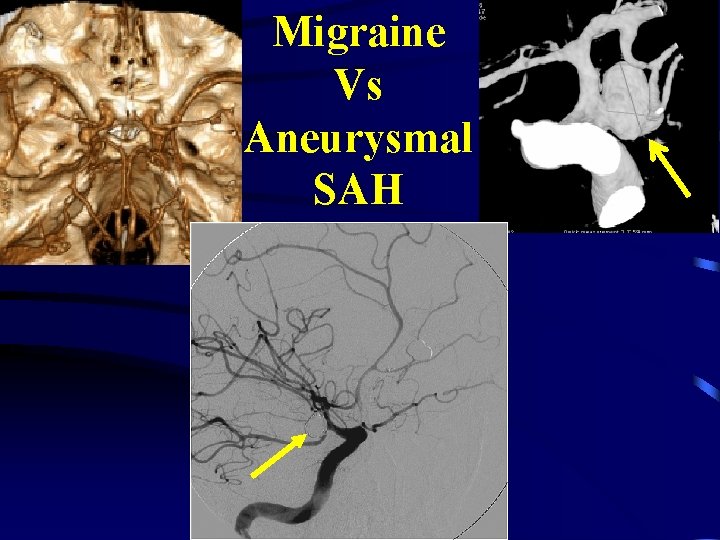 Migraine Vs Aneurysmal SAH 