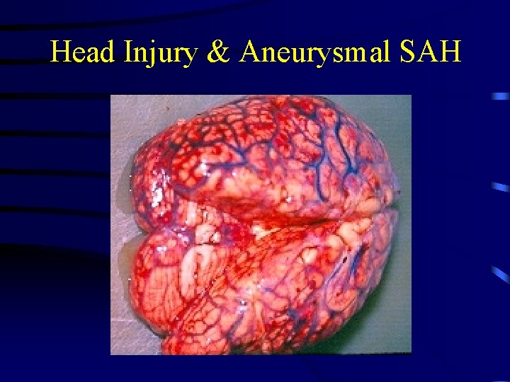 Head Injury & Aneurysmal SAH 