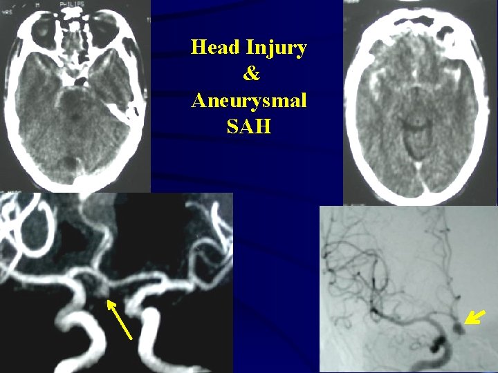 Head Injury & Aneurysmal SAH 