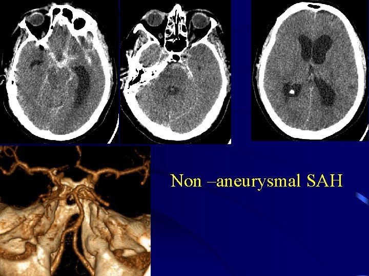 Non –aneurysmal SAH 