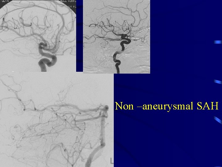 Non –aneurysmal SAH 