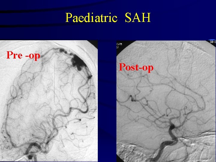 Paediatric SAH Pre -op Post-op 