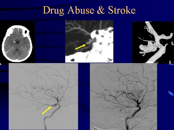 Drug Abuse & Stroke 