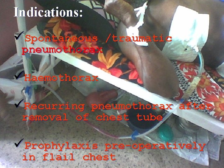 Indications: üSpontaneous /traumatic pneumothorax üHaemothorax üRecurring pneumothorax after removal of chest tube üProphylaxis pre-operatively