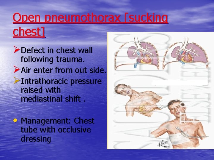 Open pneumothorax [sucking chest] ØDefect in chest wall following trauma. ØAir enter from out