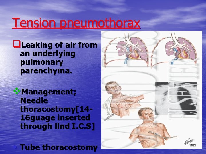 Tension pneumothorax q. Leaking of air from an underlying pulmonary parenchyma. v. Management; Needle