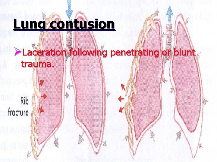 Lung contusion ØLaceration following penetrating or blunt trauma. 