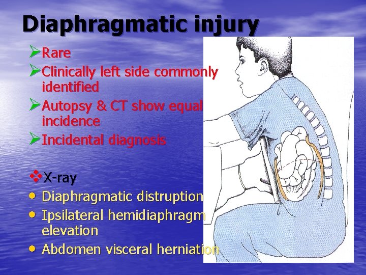 Diaphragmatic injury ØRare ØClinically left side commonly identified ØAutopsy & CT show equal incidence