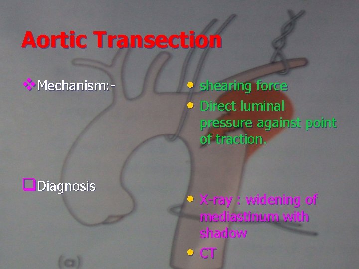 Aortic Transection v. Mechanism: - • shearing force • Direct luminal pressure against point