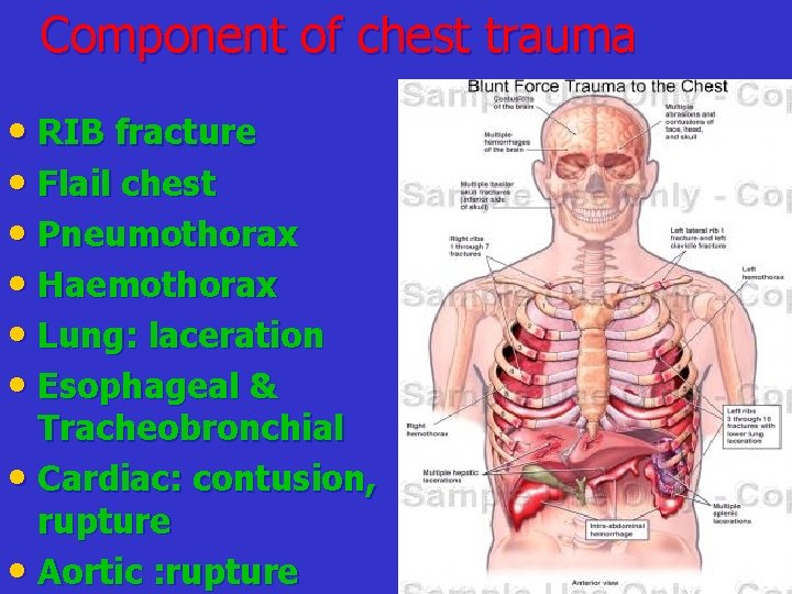 Component of chest trauma • RIB fracture • Flail chest • Pneumothorax • Haemothorax