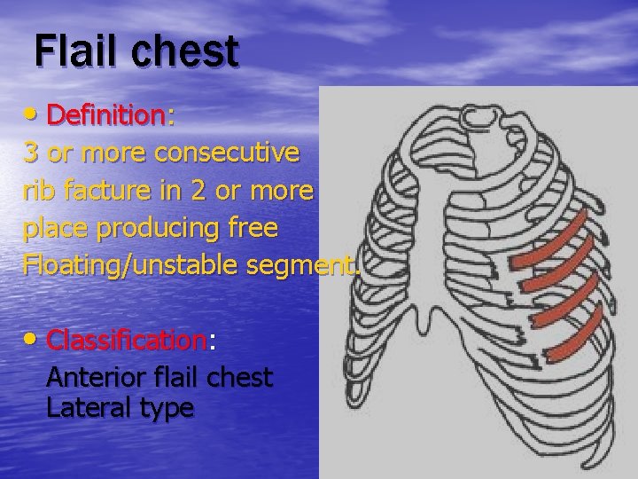 Flail chest • Definition: 3 or more consecutive rib facture in 2 or more