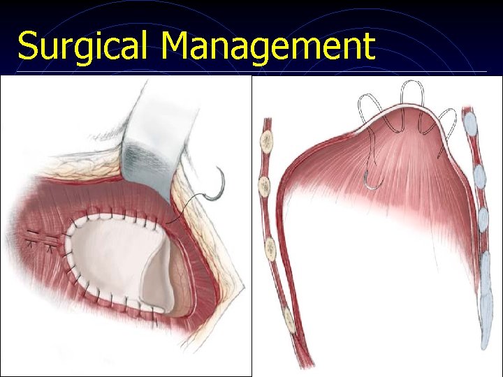 Surgical Management 