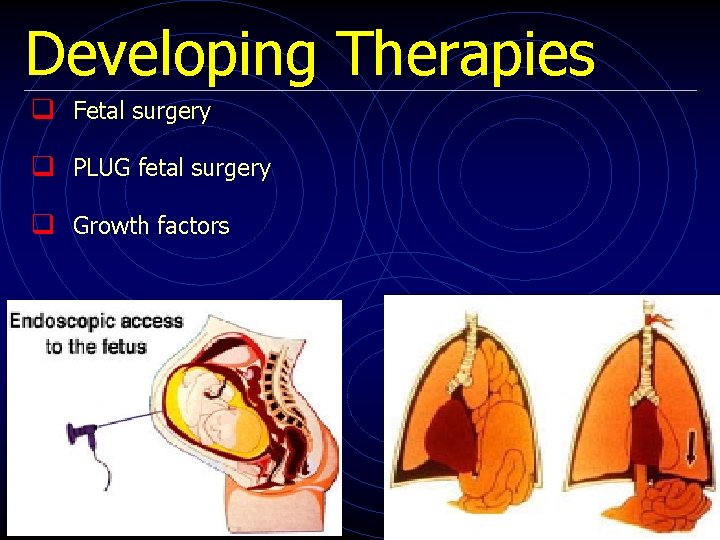 Developing Therapies q Fetal surgery q PLUG fetal surgery q Growth factors 
