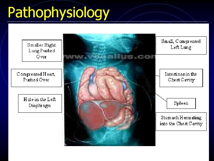 Pathophysiology 