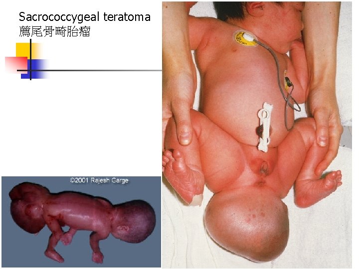 Sacrococcygeal teratoma 薦尾骨畸胎瘤 
