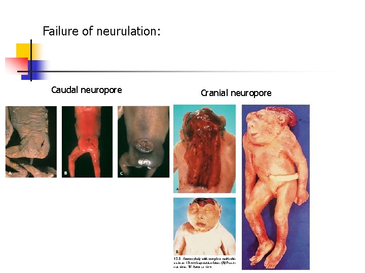 Failure of neurulation: Caudal neuropore Cranial neuropore 