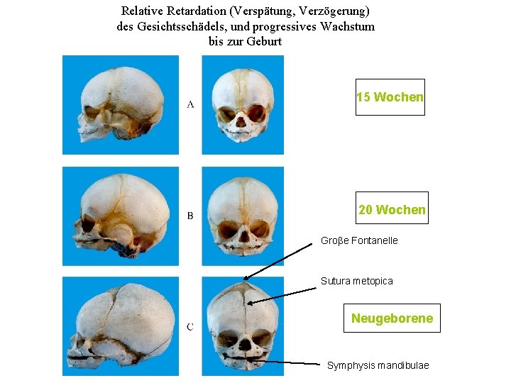 Relative Retardation (Verspätung, Verzögerung) des Gesichtsschädels, und progressives Wachstum bis zur Geburt 15 Wochen