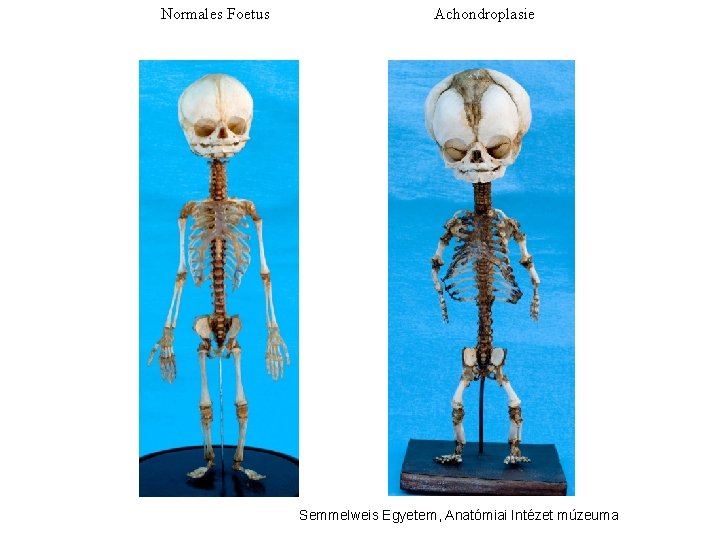 Normales Foetus Achondroplasie Semmelweis Egyetem, Anatómiai Intézet múzeuma 