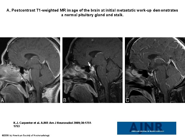 A, Postcontrast T 1 -weighted MR image of the brain at initial metastatic work-up