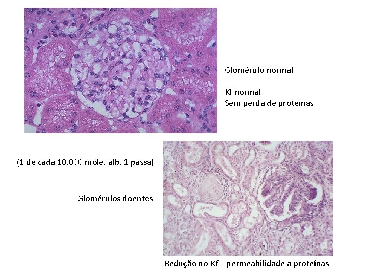 Glomérulo normal Kf normal Sem perda de proteínas (1 de cada 10. 000 mole.