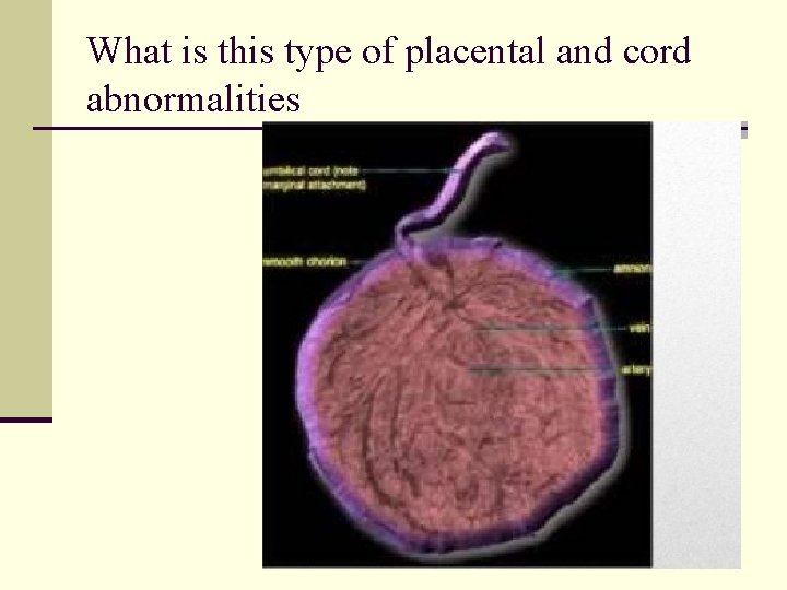 What is this type of placental and cord abnormalities 