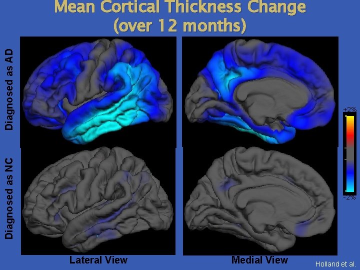 Diagnosed as AD Mean Cortical Thickness Change (over 12 months) Diagnosed as NC +2%