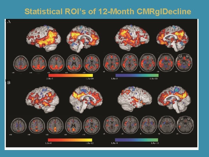 Statistical ROI’s of 12 -Month CMRgl. Decline AD MCI 
