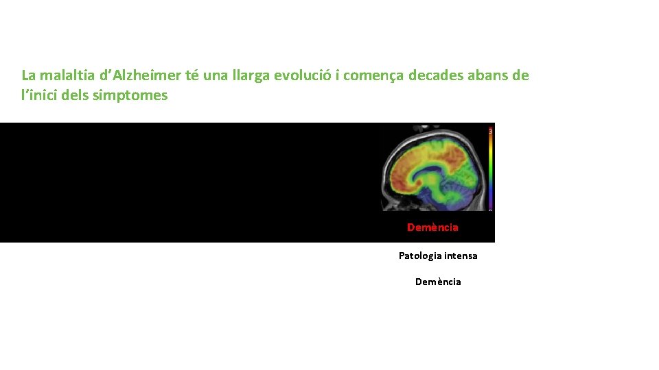 Malaltia d’Alzheimer: un nou paradigma La malaltia d’Alzheimer té una llarga evolució i comença