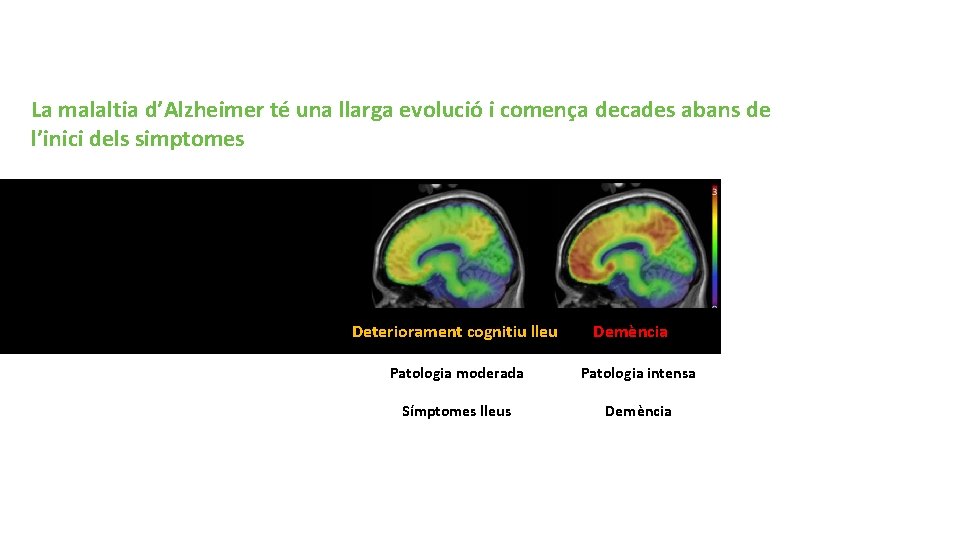 Malaltia d’Alzheimer La malaltia d’Alzheimer té una llarga evolució i comença decades abans de