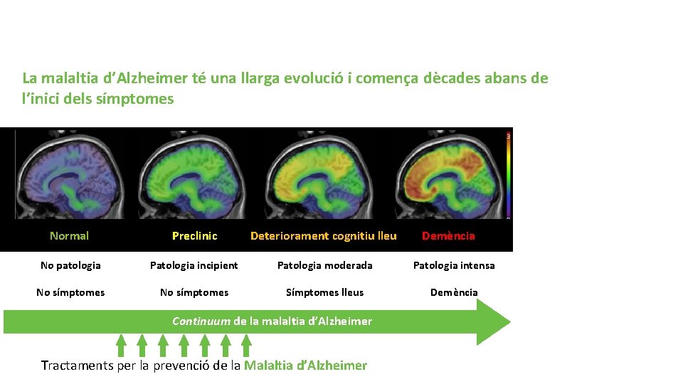 Malaltia d’Alzheimer La malaltia d’Alzheimer té una llarga evolució i comença dècades abans de