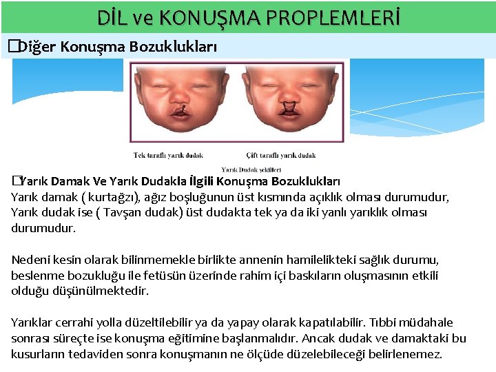 DİL ve KONUŞMA PROPLEMLERİ � Diğer Konuşma Bozuklukları � Yarık Damak Ve Yarık Dudakla