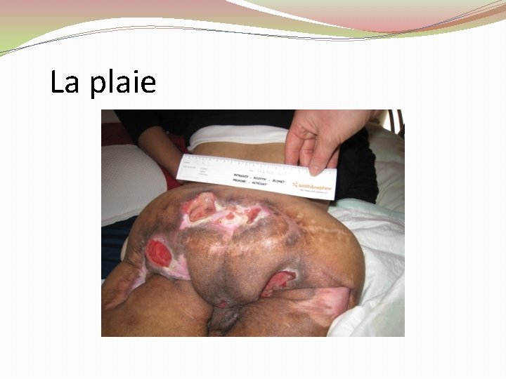 La plaie La plaie