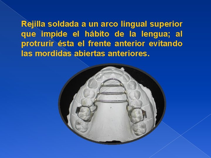 Rejilla soldada a un arco lingual superior que impide el hábito de la lengua;