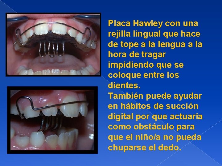 Placa Hawley con una rejilla lingual que hace de tope a la lengua a